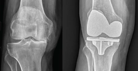 riabilitazione protesi ginocchio